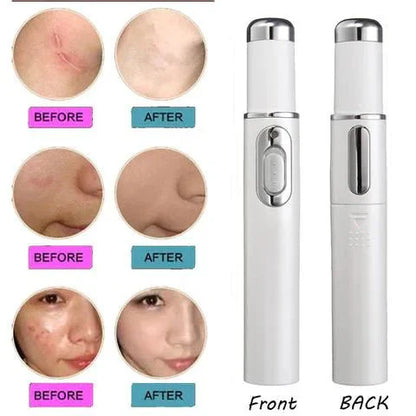 Blue Light Therapy Acne Laser Pen - Scar & Blemish Reduction-1