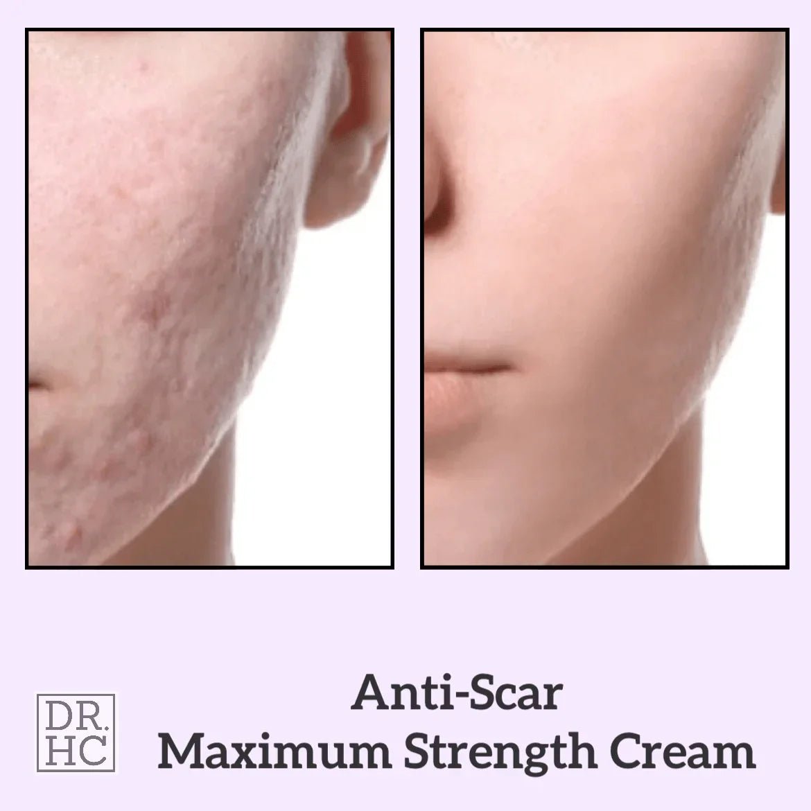 DR.HC Anti-Scar Maximum Strength Cream (10g, 0.35oz.) (Anti-scar, Skin Recovery, Anti-blemish, Anti-inflammatory...)Moisturizer Spot Care