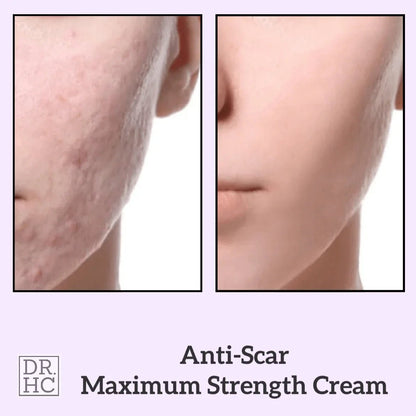 DR.HC Anti-Scar Maximum Strength Cream (10g, 0.35oz.) (Anti-scar, Skin Recovery, Anti-blemish, Anti-inflammatory...)Moisturizer Spot Care