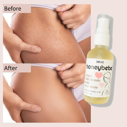 DR.HC Honeybebe' Bye-Bye Stretch Mark Mama Belly Serum (100% Organic, Natural & Vegan) (70ml, 2.4 fl.oz.) (Stretch Mark Prevention & Removal)Pregnancy