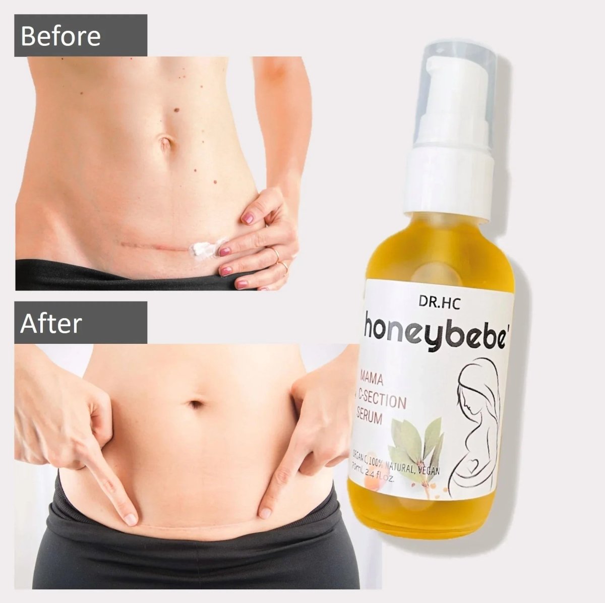 DR.HC Honeybebe' Mama C-Section Serum (100% Organic, Natural & Vegan) (70ml, 2.4 fl.oz.)Pregnancy